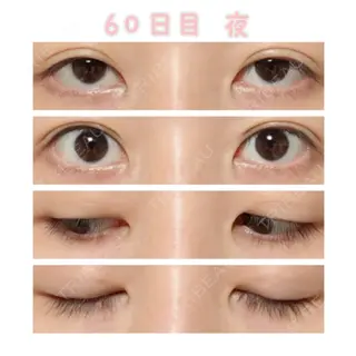 60日目の経過画像（2枚目）