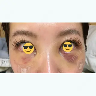 3日目の経過画像（1枚目）