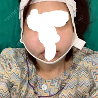 0日目の経過画像（1枚目）