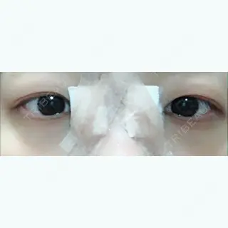 0日目の経過画像（1枚目）