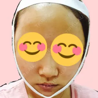 3日目の経過画像（1枚目）