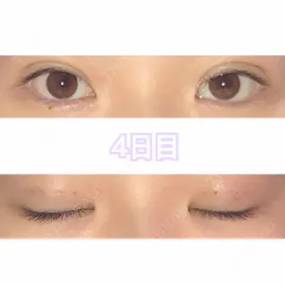 4日目の経過画像（1枚目）