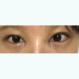 2日目の経過画像（1枚目）