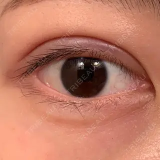 1日目の経過画像（1枚目）