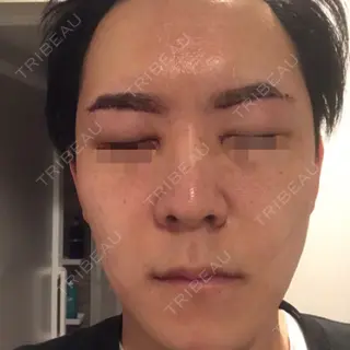 1日目の経過画像（1枚目）