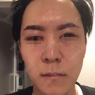 2日目の経過画像（1枚目）