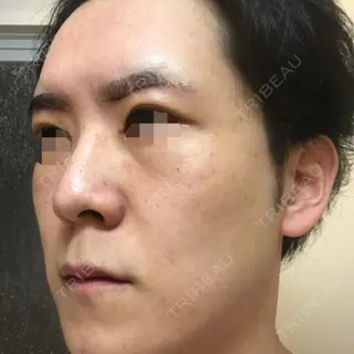 4日目の経過画像（2枚目）