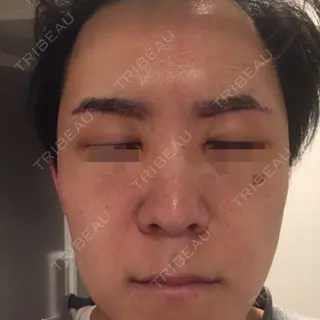 5日目の経過画像（2枚目）