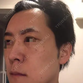 5日目の経過画像（3枚目）