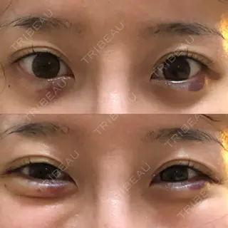 6日目の経過画像（1枚目）