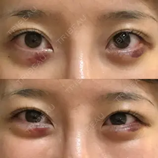 5日目の経過画像（1枚目）