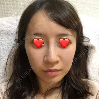 5日目の経過画像（3枚目）