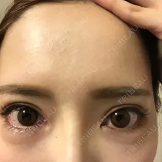 14日目の経過画像（1枚目）
