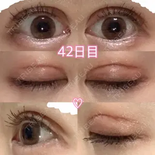 41日目の経過画像（1枚目）