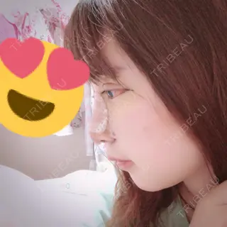 4日目の経過画像（2枚目）