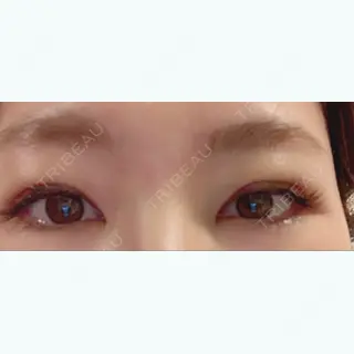 3日目の経過画像（2枚目）