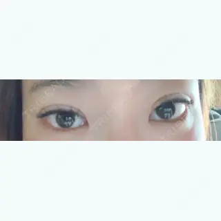 4日目の経過画像（1枚目）