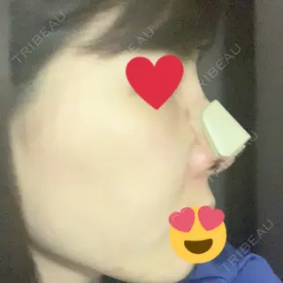 3日目の経過画像（1枚目）