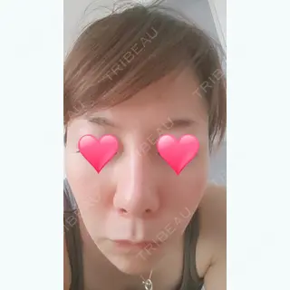 38日目の経過画像（1枚目）