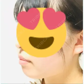 3日目の経過画像（2枚目）