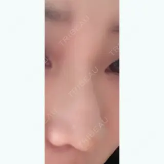 7日目の経過画像（2枚目）