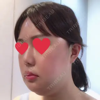 4日目の経過画像（2枚目）