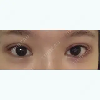 10日目の経過画像（1枚目）