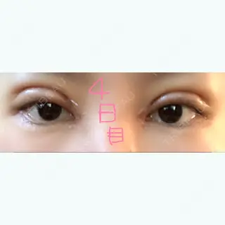 4日目の経過画像（1枚目）