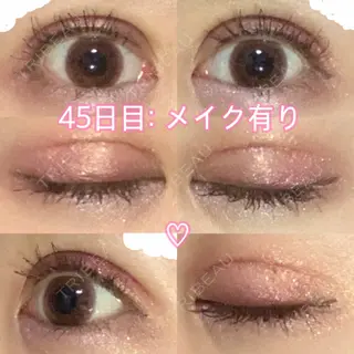 44日目の経過画像（2枚目）