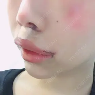 1日目の経過画像（2枚目）