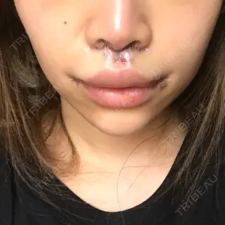 2日目の経過画像（1枚目）