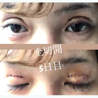 5日目の経過画像（1枚目）