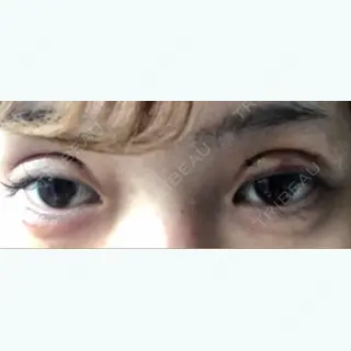 5日目の経過画像（2枚目）