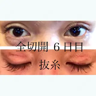 6日目の経過画像（1枚目）