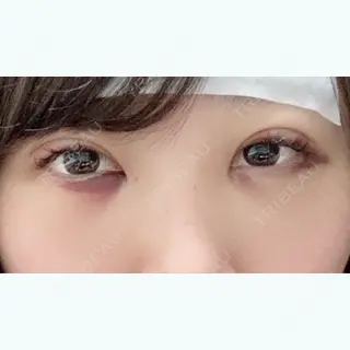 2日目の経過画像（1枚目）