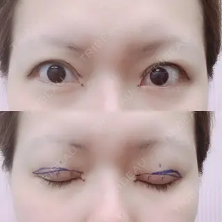 0日目の経過画像（1枚目）