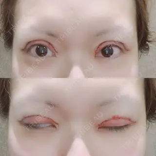 0日目の経過画像（2枚目）