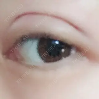 1日目の経過画像（2枚目）