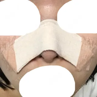 1日目の経過画像（1枚目）