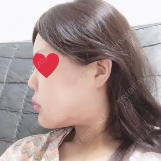7日目の経過画像（3枚目）