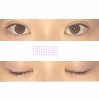 11日目の経過画像（1枚目）