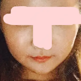 18日目の経過画像（1枚目）