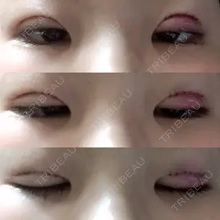 0日目の経過画像（1枚目）