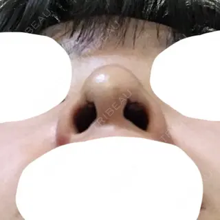 3日目の経過画像（2枚目）