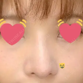 12日目の経過画像（1枚目）