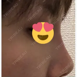 11日目の経過画像（2枚目）