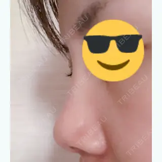 12日目の経過画像（2枚目）