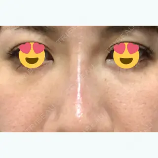 13日目の経過画像（1枚目）