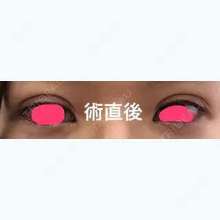 0日目の経過画像（1枚目）