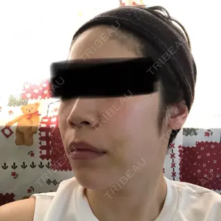 21日目の経過画像（2枚目）